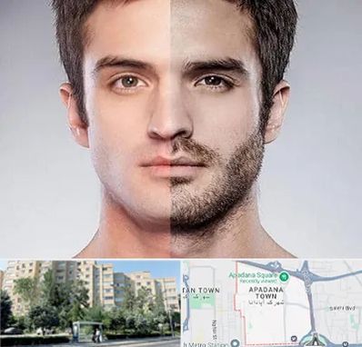 کاشت ریش و سبیل در آپادانا