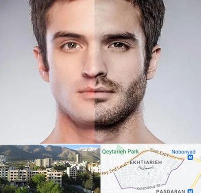 کاشت ریش و سبیل در اختیاریه