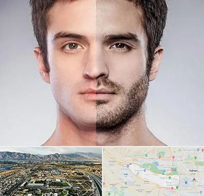 کاشت ریش و سبیل در منطقه 21 تهران