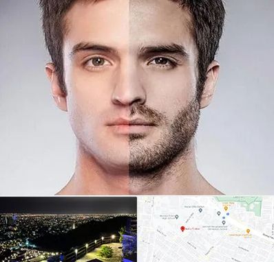 کاشت ریش و سبیل در هفت تیر مشهد