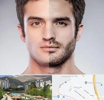 کاشت ریش و سبیل در شهر زیبا