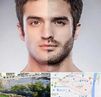 کاشت ریش و سبیل در گلستان اهواز