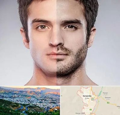 کاشت ریش و سبیل در سنندج