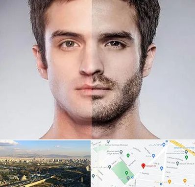 کاشت ریش و سبیل در هنگام