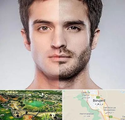 کاشت ریش و سبیل در بروجرد