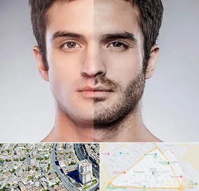 کاشت ریش و سبیل در قاسم آباد مشهد