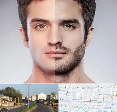 کاشت ریش و سبیل در ضیابری رشت