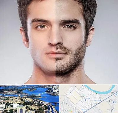 کاشت ریش و سبیل در کوروش اهواز