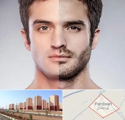 کاشت ریش و سبیل در پردیسان قم