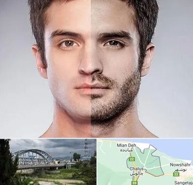 کاشت ریش و سبیل در چالوس