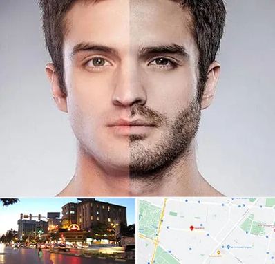 کاشت ریش و سبیل در بلوار سجاد مشهد