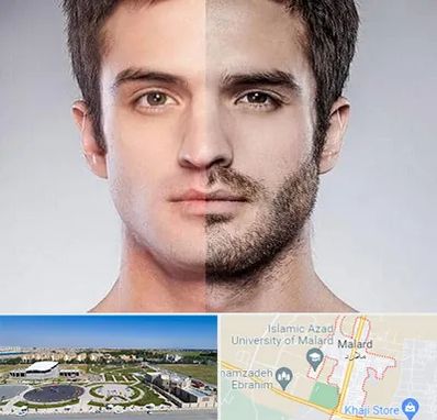 کاشت ریش و سبیل در ملارد