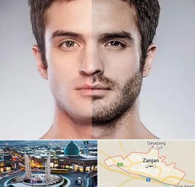 کاشت ریش و سبیل در زنجان