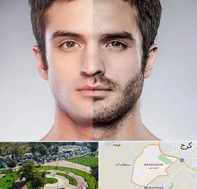 کاشت ریش و سبیل در مهرشهر کرج