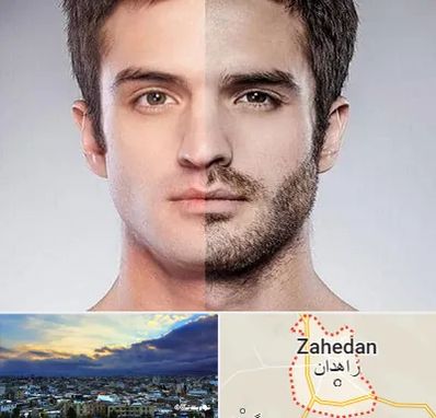 کاشت ریش و سبیل در زاهدان