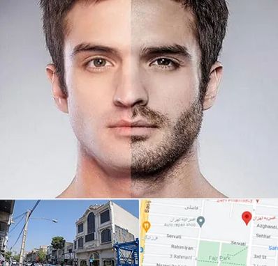 کاشت ریش و سبیل در افسریه