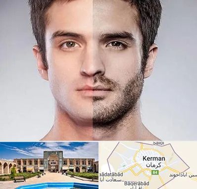 کاشت ریش و سبیل در کرمان