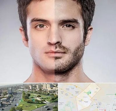 کاشت ریش و سبیل در کمال شهر کرج