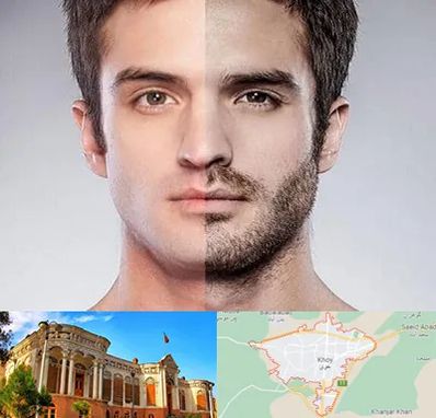 کاشت ریش و سبیل در خوی