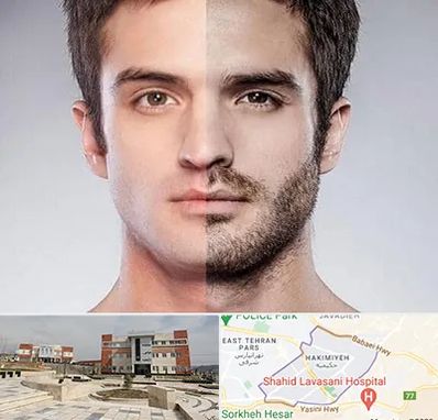 کاشت ریش و سبیل در حکیمیه