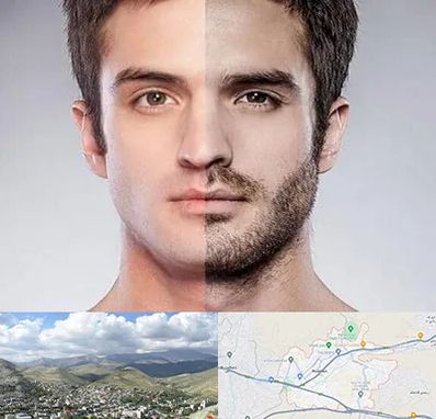 کاشت ریش و سبیل در رودهن