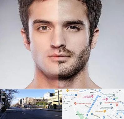 کاشت ریش و سبیل در خیابان ملاصدرا شیراز