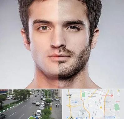 کاشت ریش و سبیل در ستارخان