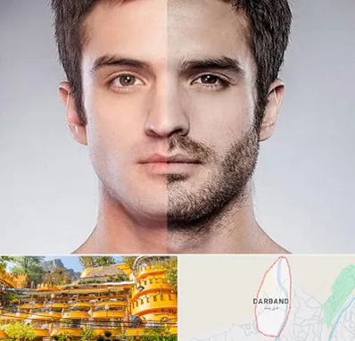 کاشت ریش و سبیل در دربند