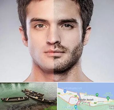 کاشت ریش و سبیل در بندر انزلی