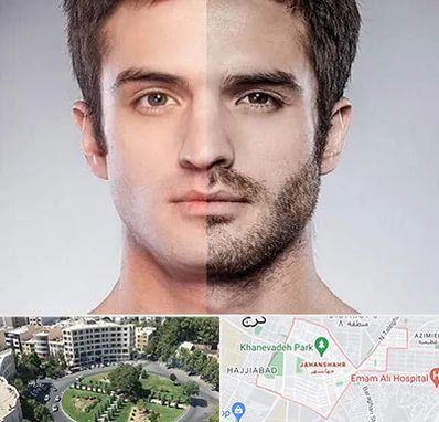 کاشت ریش و سبیل در جهانشهر کرج