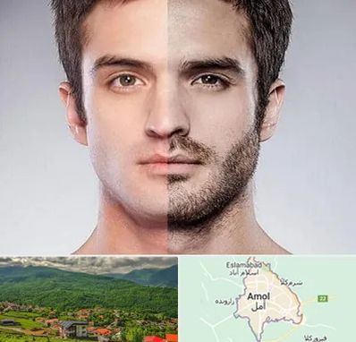 کاشت ریش و سبیل در آمل