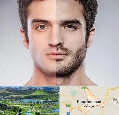 کاشت ریش و سبیل در خرم آباد