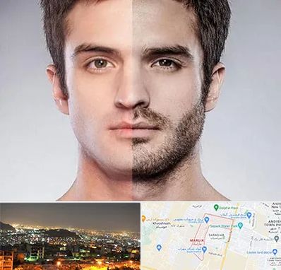 کاشت ریش و سبیل در مارلیک کرج