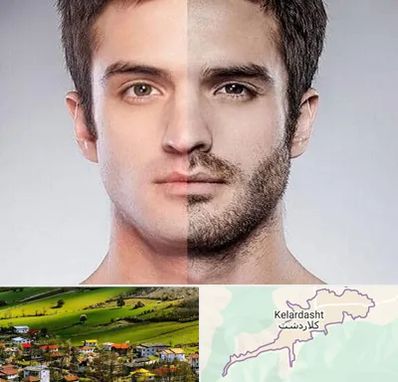 کاشت ریش و سبیل در کلاردشت