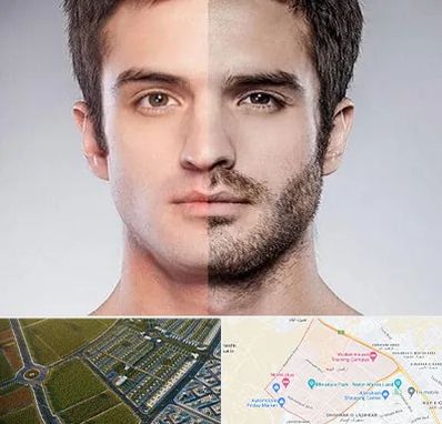 کاشت ریش و سبیل در الهیه مشهد