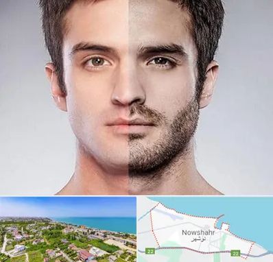 کاشت ریش و سبیل در نوشهر