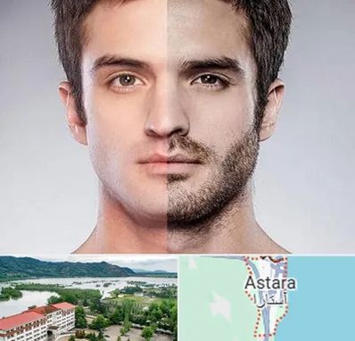 کاشت ریش و سبیل در آستارا