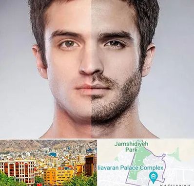 کاشت ریش و سبیل در نیاوران