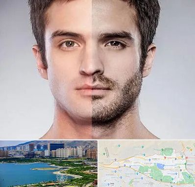 کاشت ریش و سبیل در منطقه 22 تهران