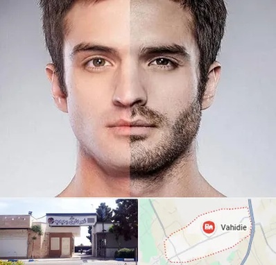 کاشت ریش و سبیل در وحیدیه شهریار