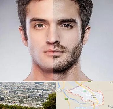 کاشت ریش و سبیل در یاسوج