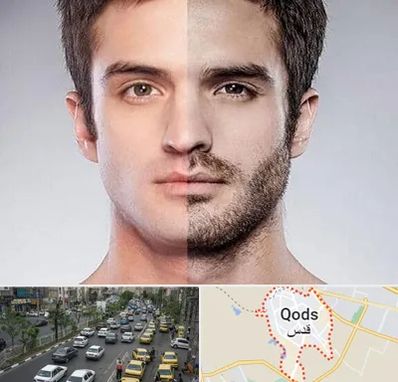 کاشت ریش و سبیل در شهر قدس