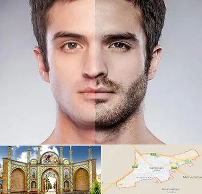 کاشت ریش و سبیل در سمنان