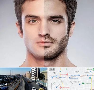 کاشت ریش و سبیل در پیروزی