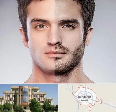 کاشت ریش و سبیل در دهدشت