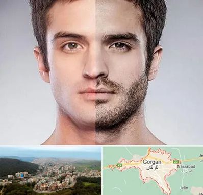 کاشت ریش و سبیل در گرگان