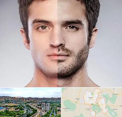 کاشت ریش و سبیل در شهریار