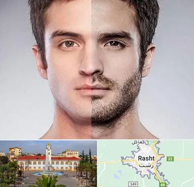 کاشت ریش و سبیل در رشت