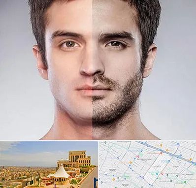 کاشت ریش و سبیل در هاشمیه مشهد