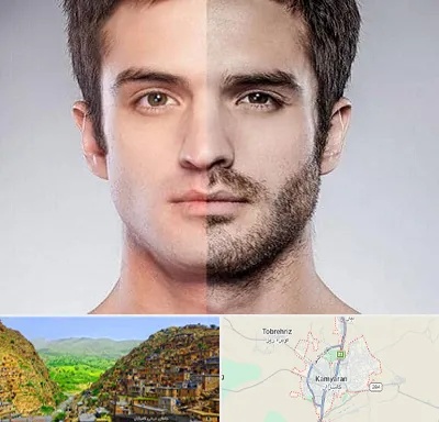 کاشت ریش و سبیل در کامیاران